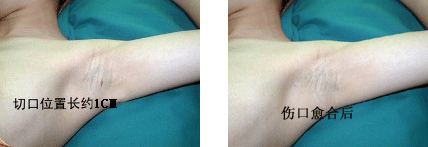 (改良小切口汗腺清除术)改良小切口汗腺清除术术后示意图.gif